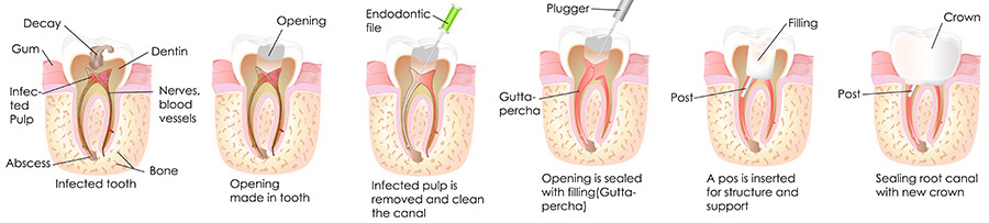 Rialto dentist | root canals | Rialto Family Dental Center